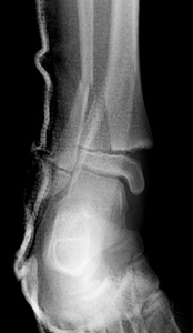 Figure 4 Salter Harris II distal tibia Figure 4 Salter Harris II distal tibia
